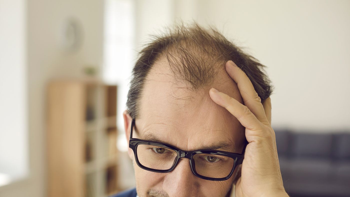 Cara Mengatasi Rambut Botak dengan Mudah