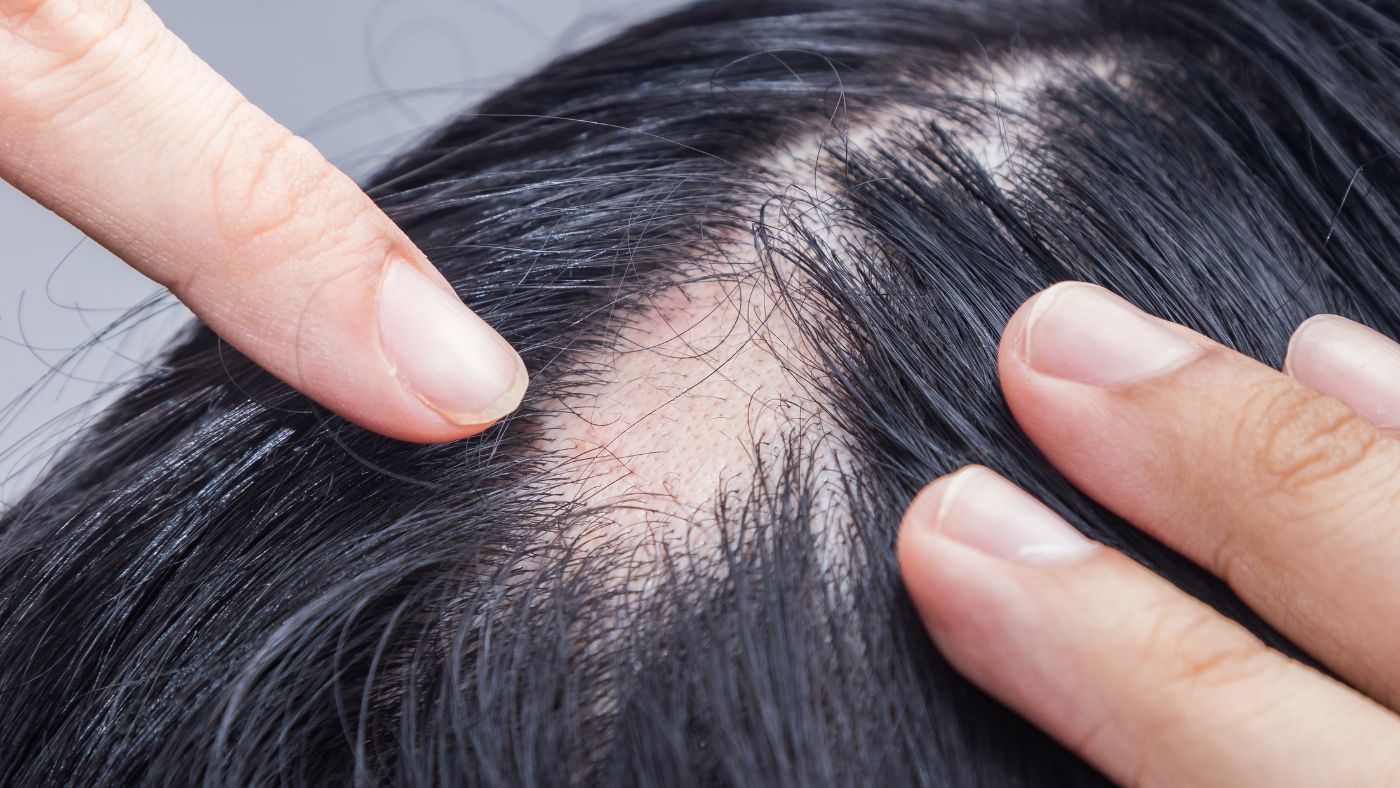 Alopecia Areata: Penyebab, Gejala, dan Pengobatan